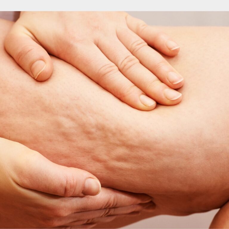 DIY Cellulite Massage Oil Recipe – Smooth and Firm Skin Naturally